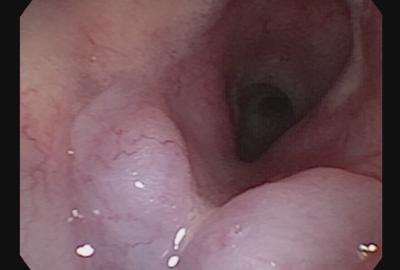 Vyhřezlé oba laryngeální váčky vlivem silného podtlaku při dýchání  - Medipet Zlín.